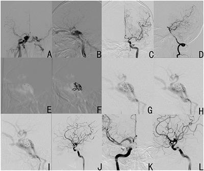 A Modified Treatment Through Point-to-Point Coil Embolization for Direct Carotid Cavernous to Fistula: A Single-Center Result